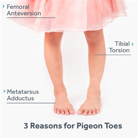 pigeon toed treatment for kids.